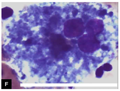 SciELO - Brasil - Niemann-Pick disease type C: a case series of